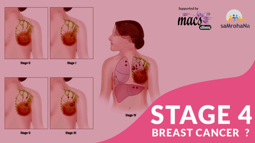 Breast Cancer Treatment Overview SamRohana   33 Stage 4 Breast Cancer Cancer 1024x576 